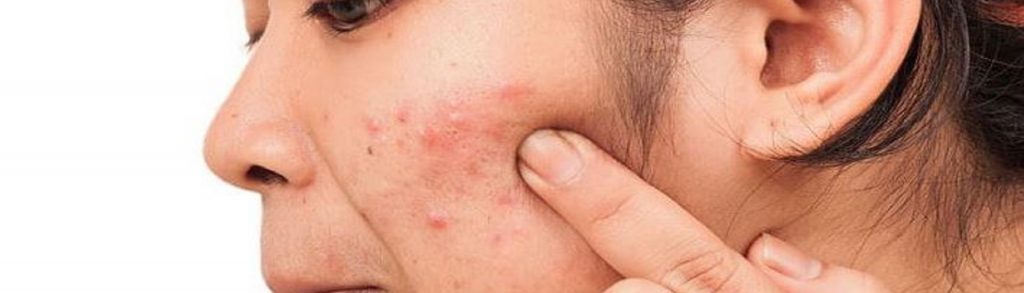 nunca debes de usar para tratar el acne