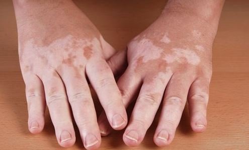 manos con vitiligo