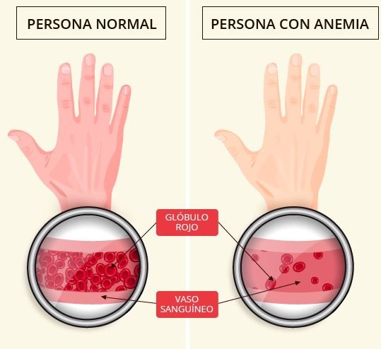 medicina natural contra la anemia megaloblastica