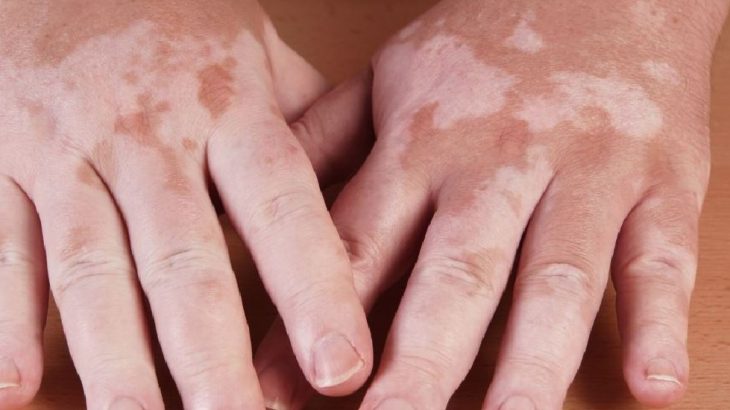 jugos para curar el vitiligo