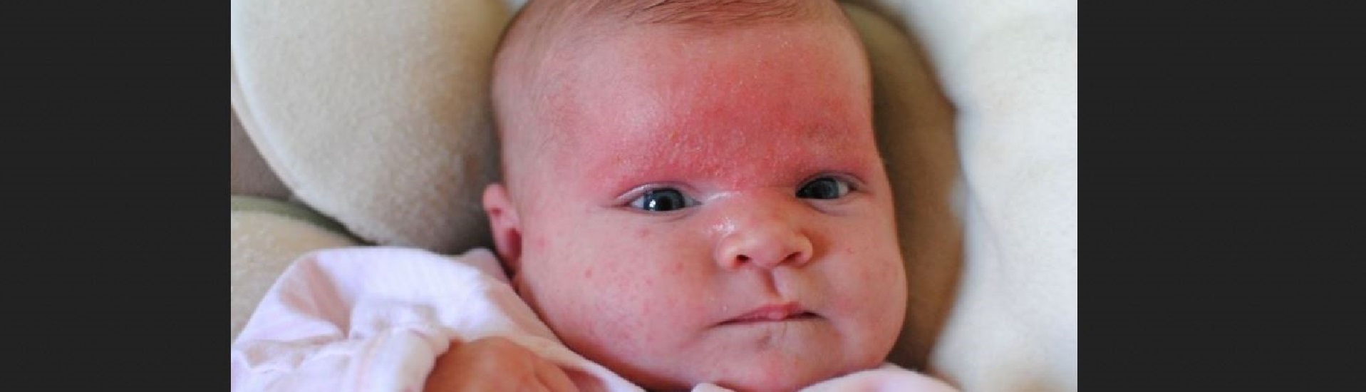 ¿Por qué mi bebé tiene sarpullido en la cara? Causas y