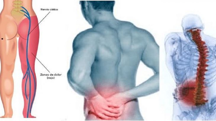 inflamacion del nervio ciatico