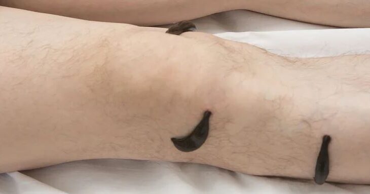 varices y sanguijuelas